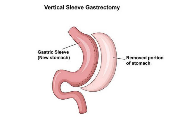 what is gastric-sleeve-vertical
