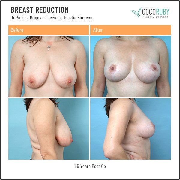 Melbourne Best Breast Reduction Before and After Photos