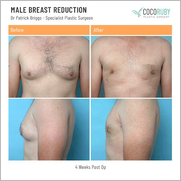 Best Gynecomastia Before and After Photos Melbourne